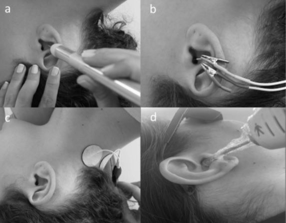 Como a Reorganização do Zumbido Pode Revelar a Eficácia dos Tratamentos: O Que Diz a Ciência?